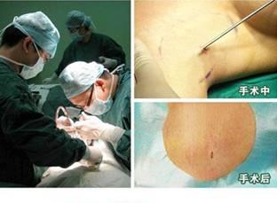 改良小切口汗腺清除术改良小切口汗腺清除术 手术过程.JPG